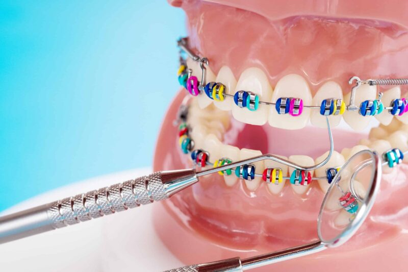 Weatherford Braces