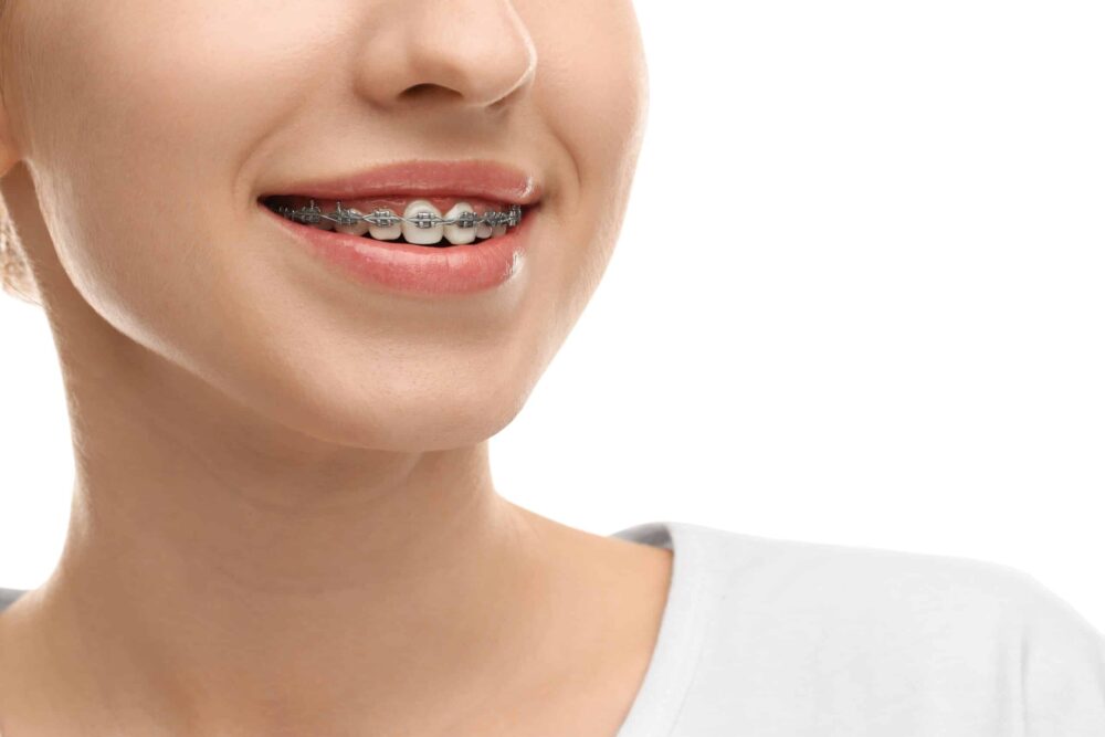 Alternatives to Braces Weatherford