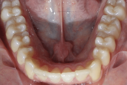 woodOrthoSmileGalleryBA10-e1711383159600