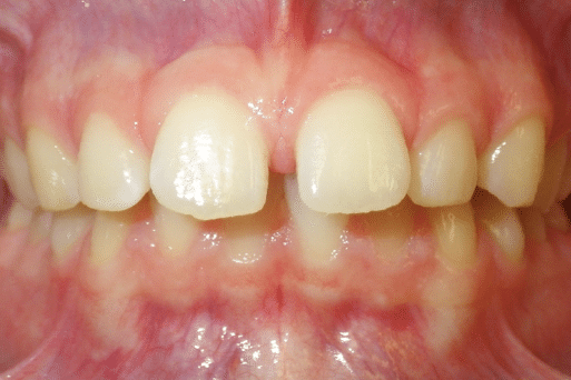 woodOrthoSmileGalleryBA11-e1711383220849