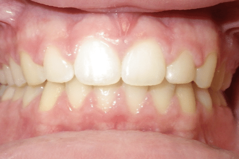 woodOrthoSmileGalleryBA12-e1711383256415