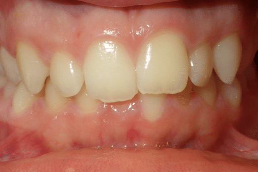 woodOrthoSmileGalleryBA13-e1711383305249