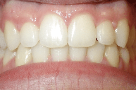 woodOrthoSmileGalleryBA14-e1711383356402