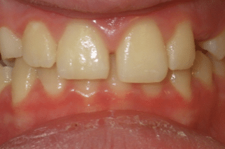 woodOrthoSmileGalleryBA15-e1711383562694