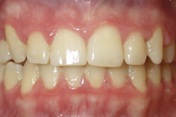 woodOrthoSmileGalleryBA16-e1711383526385