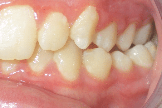 woodOrthoSmileGalleryBA17-e1711383621341