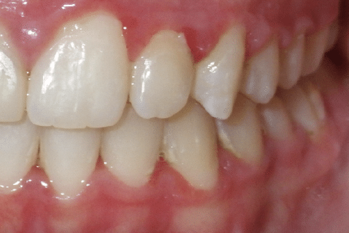 woodOrthoSmileGalleryBA18-e1711383643145