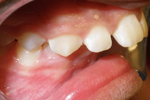 woodOrthoSmileGalleryBA19-e1711383698744