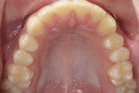 woodOrthoSmileGalleryBA2-e1711382664418