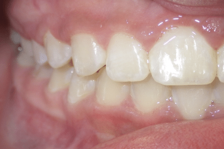 woodOrthoSmileGalleryBA20-e1711383725476