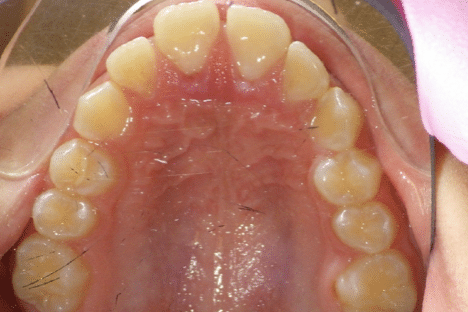 woodOrthoSmileGalleryBA22-e1711383820144