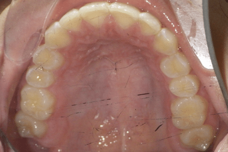 woodOrthoSmileGalleryBA23-e1711383800218