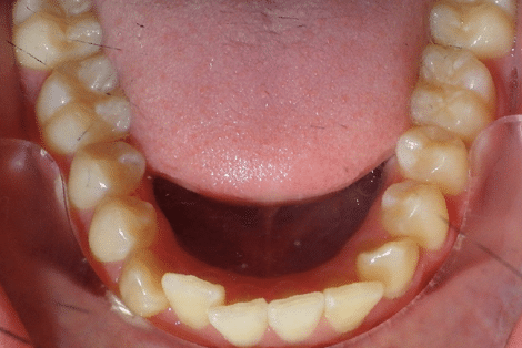 woodOrthoSmileGalleryBA24-e1711383999711