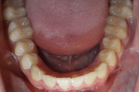 woodOrthoSmileGalleryBA25-e1711384021966