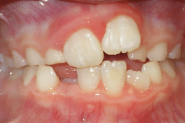 woodOrthoSmileGalleryBA26-e1711384071148