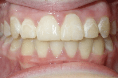 woodOrthoSmileGalleryBA27-e1711384092468