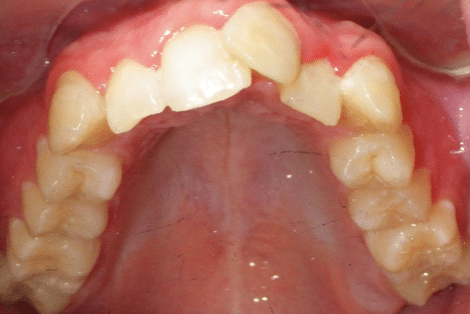 woodOrthoSmileGalleryBA28-e1711384139937