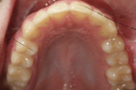 woodOrthoSmileGalleryBA29-e1711384162729