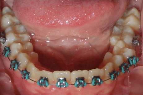 woodOrthoSmileGalleryBA3-e1711382763496