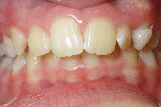 woodOrthoSmileGalleryBA30-e1711384218364