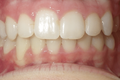 woodOrthoSmileGalleryBA31-e1711384353865