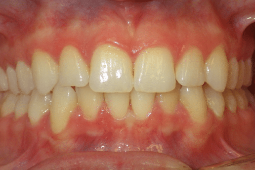 woodOrthoSmileGalleryBA32-e1711384406342