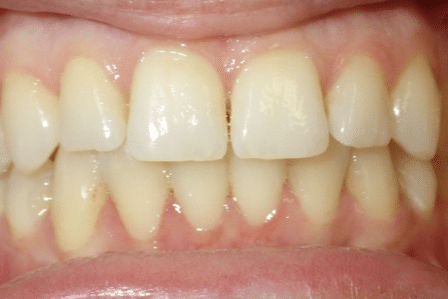 woodOrthoSmileGalleryBA33-e1711384435249
