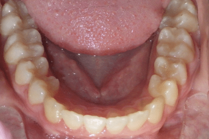 woodOrthoSmileGalleryBA4-e1711382787952