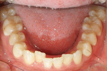 woodOrthoSmileGalleryBA5-e1711382867265