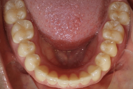 woodOrthoSmileGalleryBA6-e1711382892453