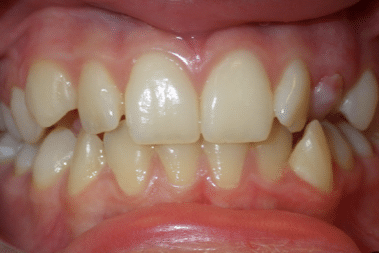woodOrthoSmileGalleryBA7-e1711383012922