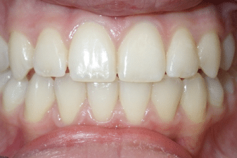 woodOrthoSmileGalleryBA8-e1711383070587