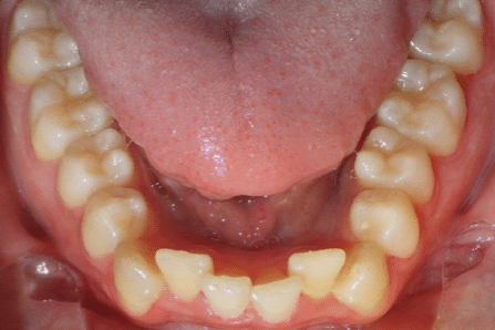 woodOrthoSmileGalleryBA9-e1711383128955